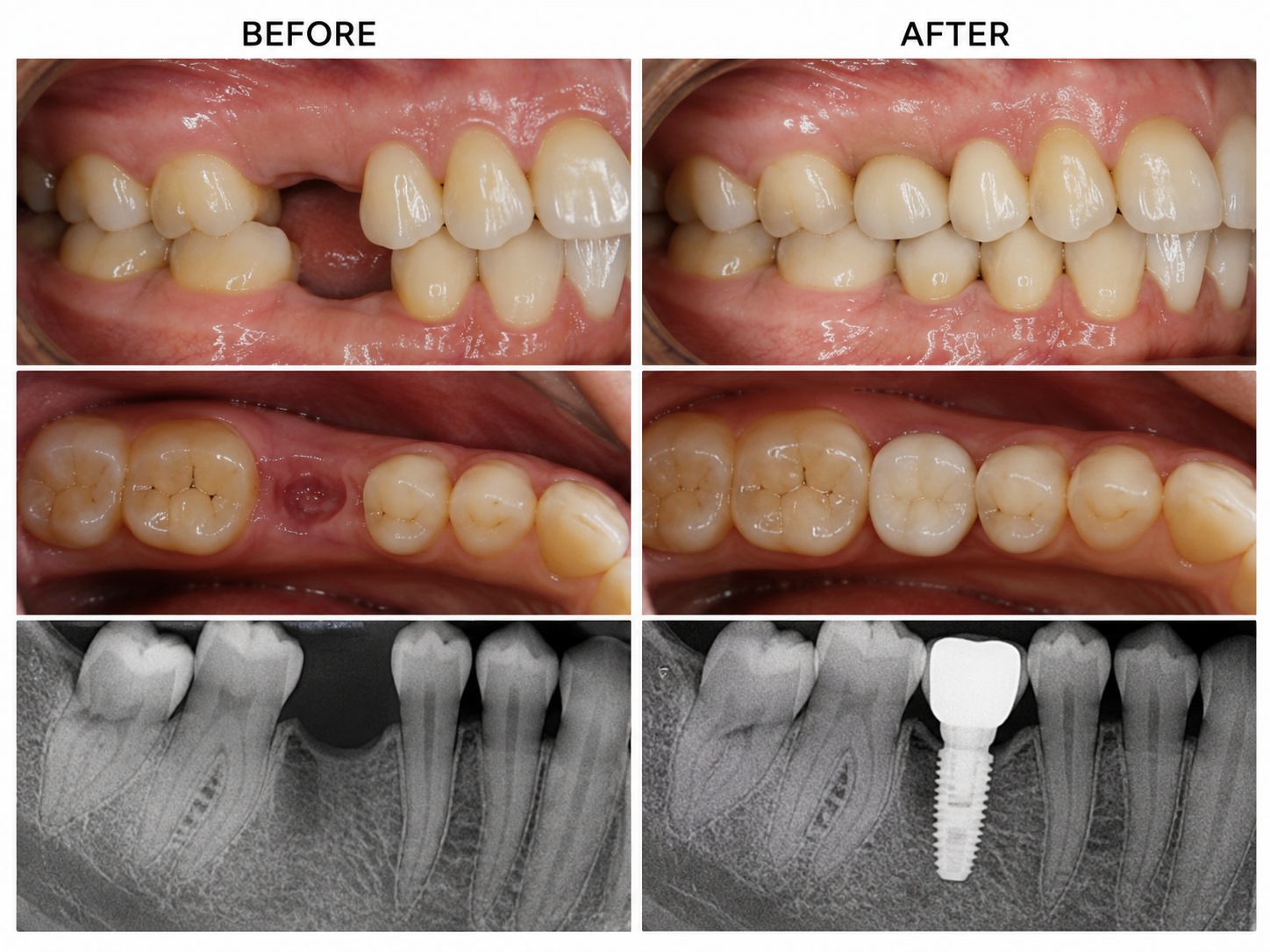 Dental Implant Before and After treatment result